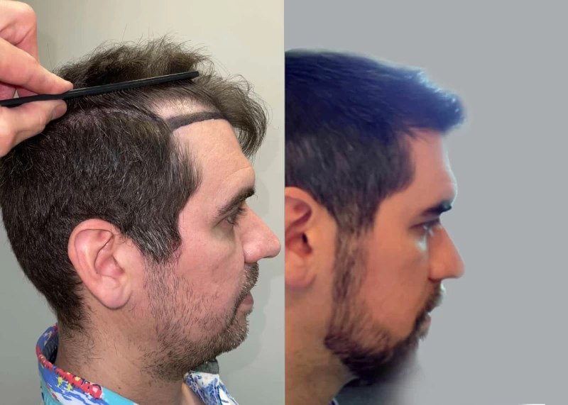 Patient p437 hair transplant before and after right view
