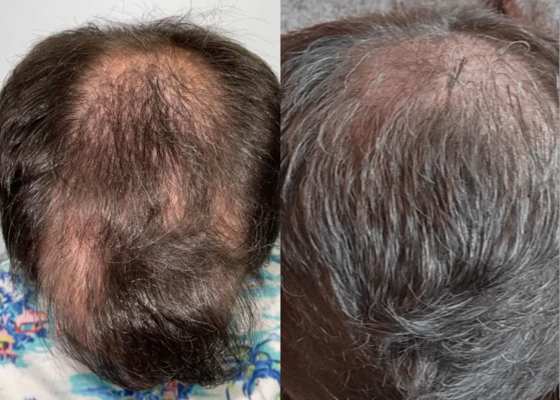 Patient p437 hair transplant before and after tilt view