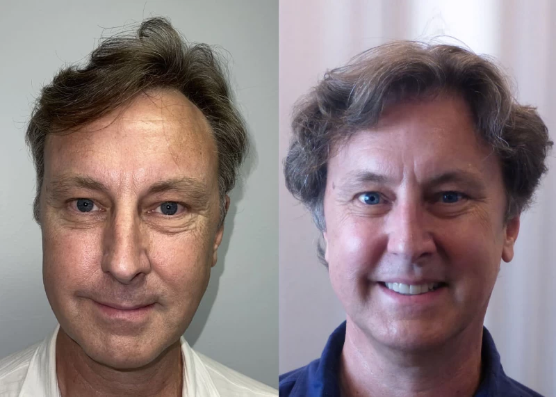 Mark Hair Transplant Before and After