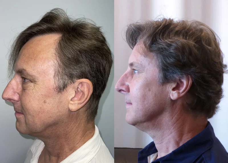 Patient p438 hair transplant before and after left view