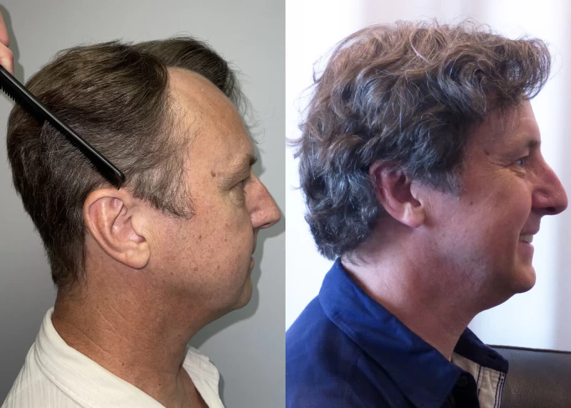 Patient p438 hair transplant before and after right view