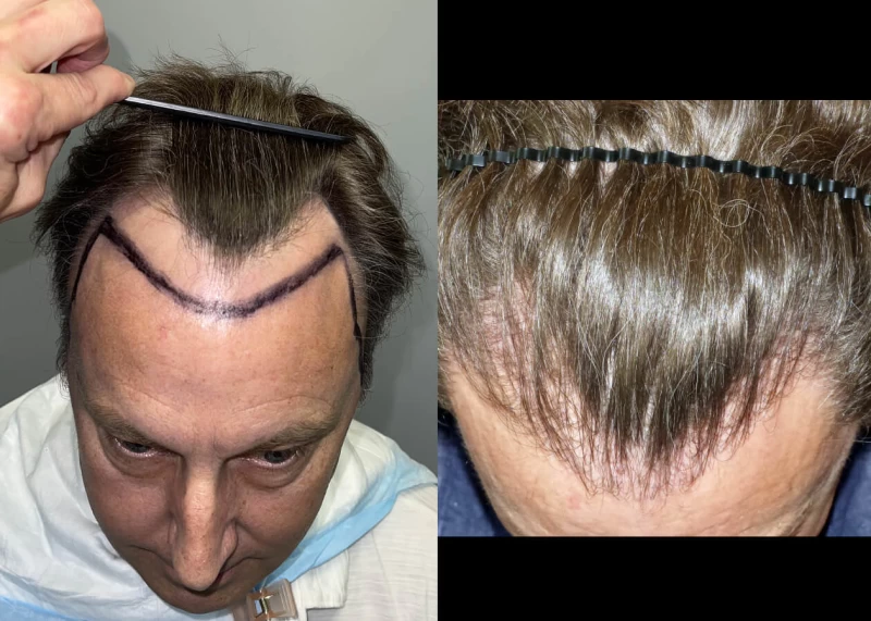 Patient p438 hair transplant before and after tilt view
