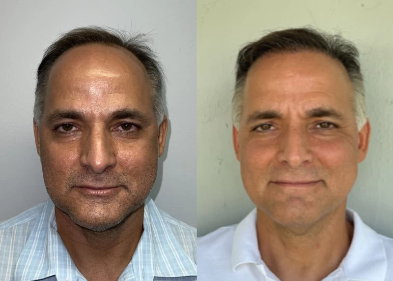 Luis Hair Transplant Before and After