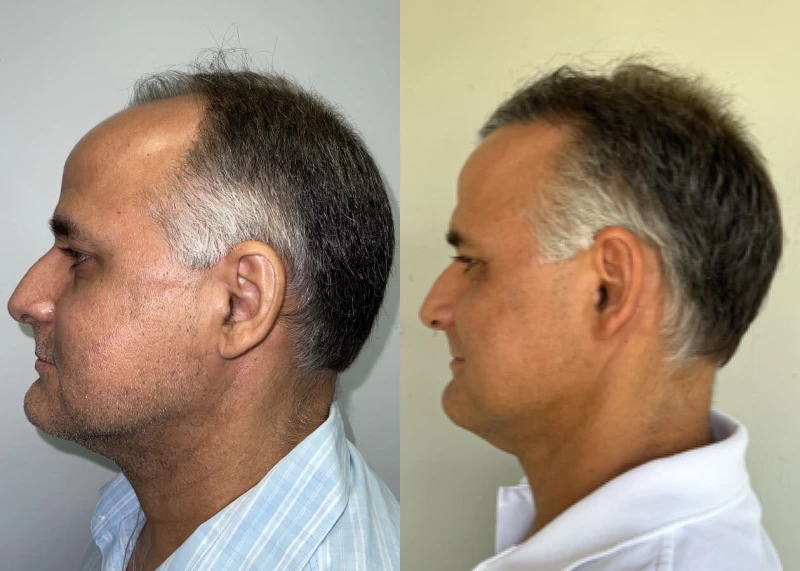 Patient p439 hair transplant before and after left view