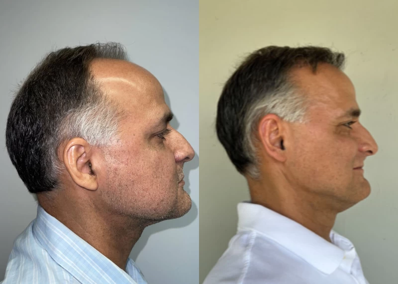 Patient p439 hair transplant before and after right view