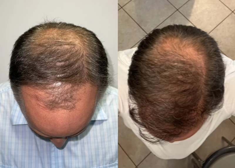 Patient p439 hair transplant before and after tilt view