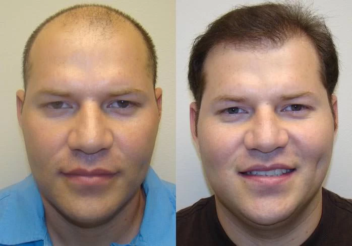 Josh Hair Transplant Before and After