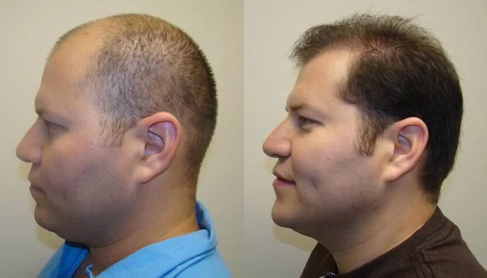 Patient p43 hair transplant before and after left view