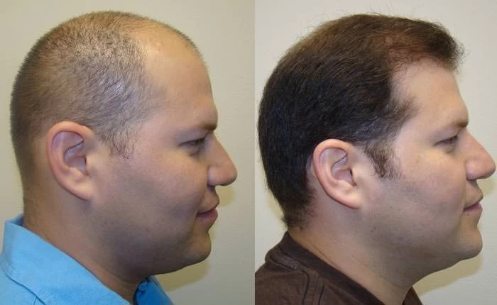 Patient p43 hair transplant before and after right view