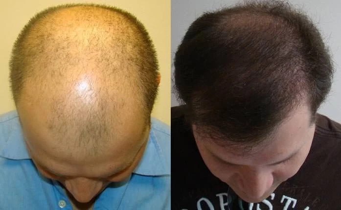 Patient p43 hair transplant before and after tilt view