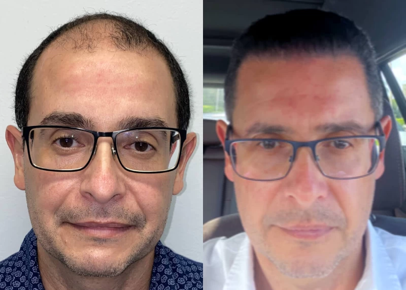 Frankie Hair Transplant Before and After