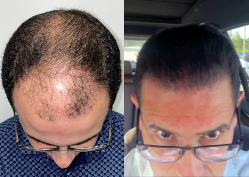 Patient p440 hair transplant before and after tilt view