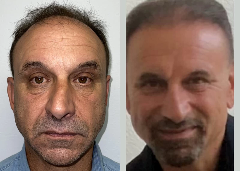 Anthony Hair Transplant Before and After