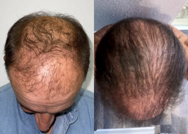 Patient p441 hair transplant before and after tilt view