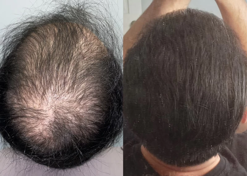 Patient p442 hair transplant before and after crown view