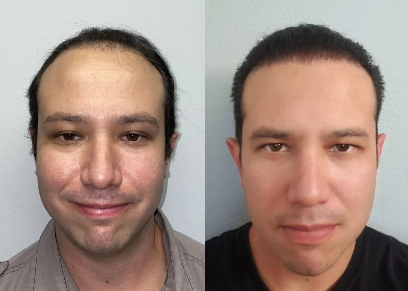 Steve Hair Transplant Before and After