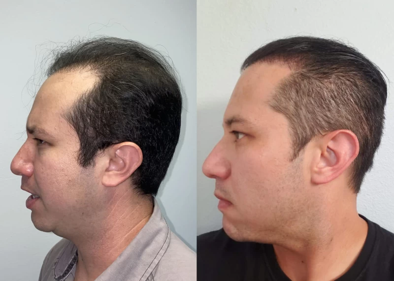 Patient p442 hair transplant before and after left view