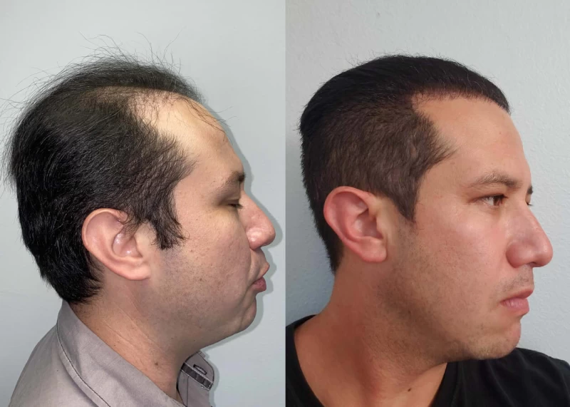 Patient p442 hair transplant before and after right view