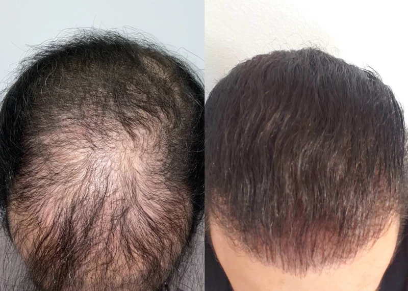 Patient p442 hair transplant before and after tilt view