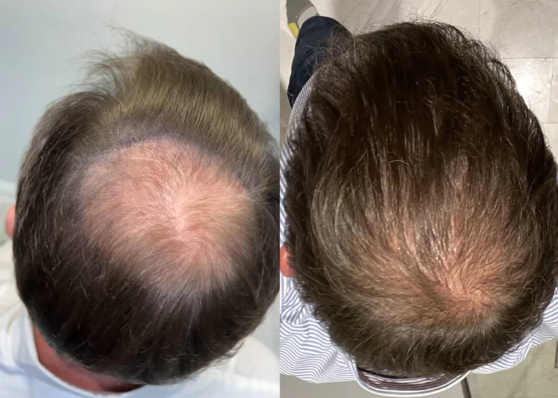 Patient p443 hair transplant before and after crown view