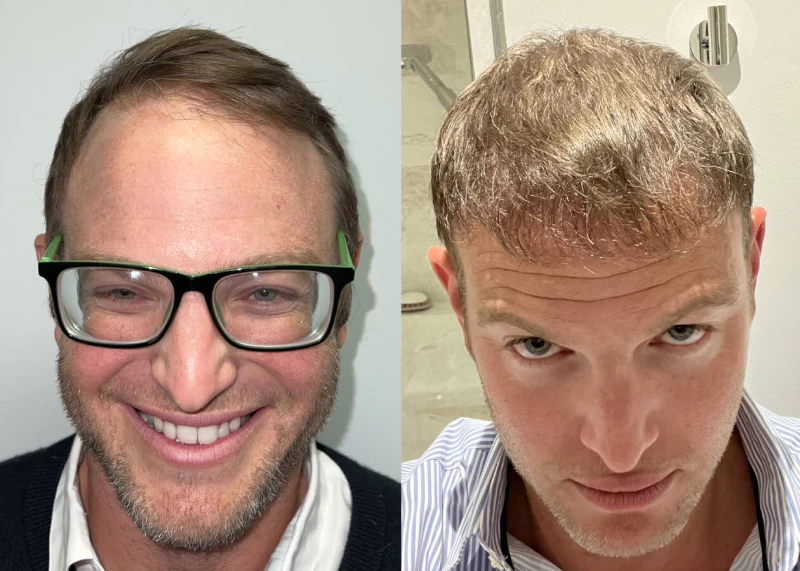 Albert Hair Transplant Before and After