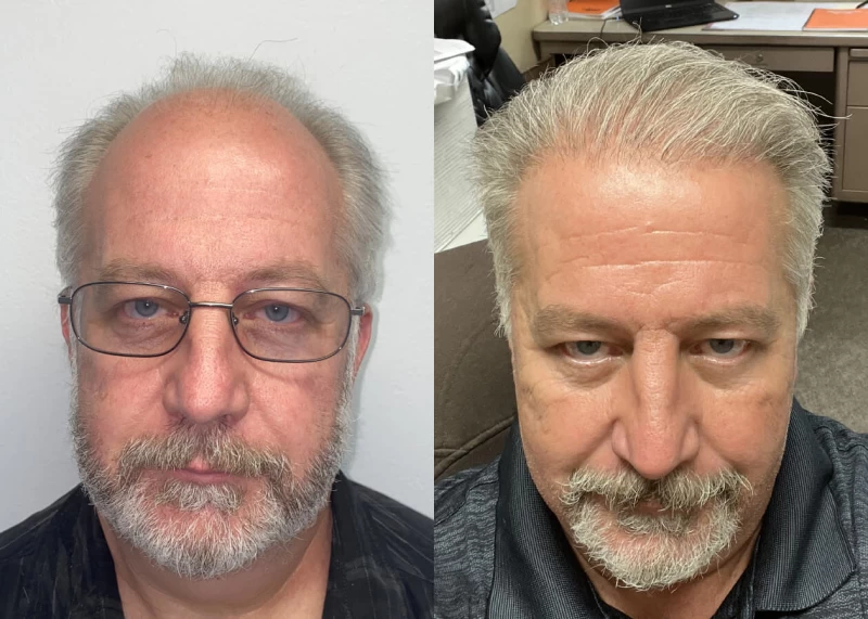 John Hair Transplant Before and After
