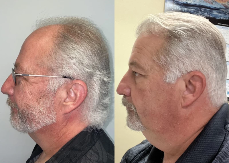 Patient p444 hair transplant before and after left view