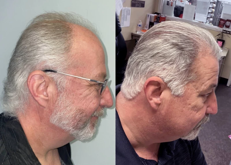 Patient p444 hair transplant before and after right view