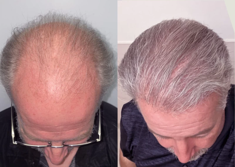 Patient p444 hair transplant before and after tilt view