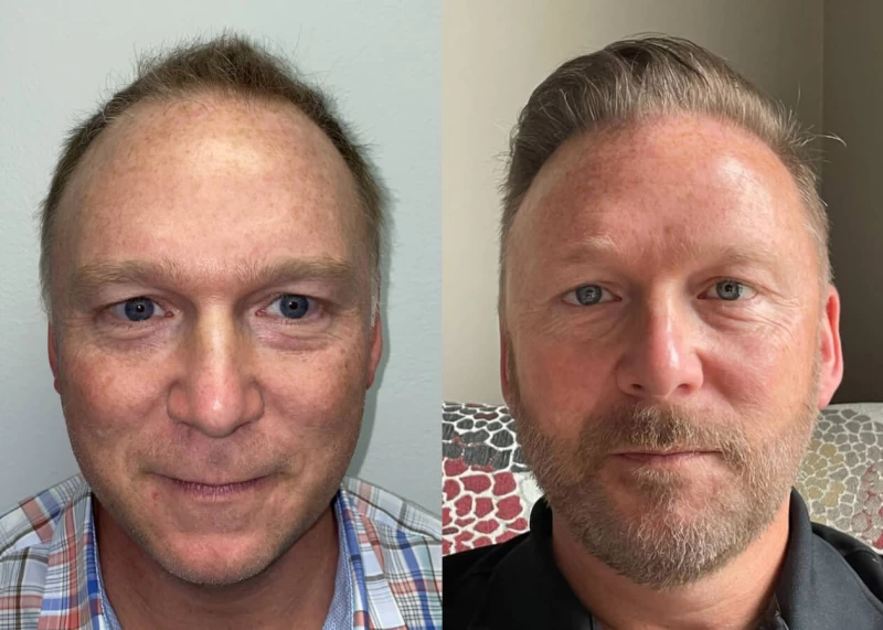Phil Hair Transplant Before and After