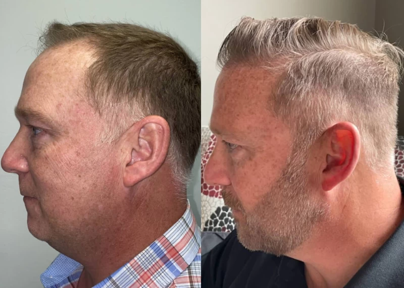 Patient p445 hair transplant before and after left view