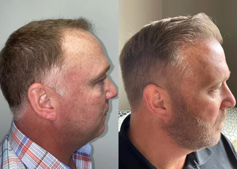 Patient p445 hair transplant before and after right view