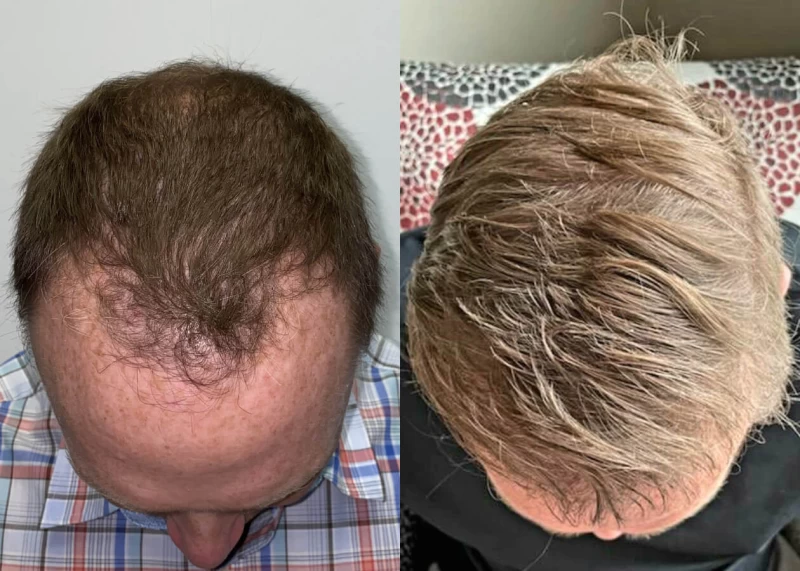 Patient p445 hair transplant before and after tilt view