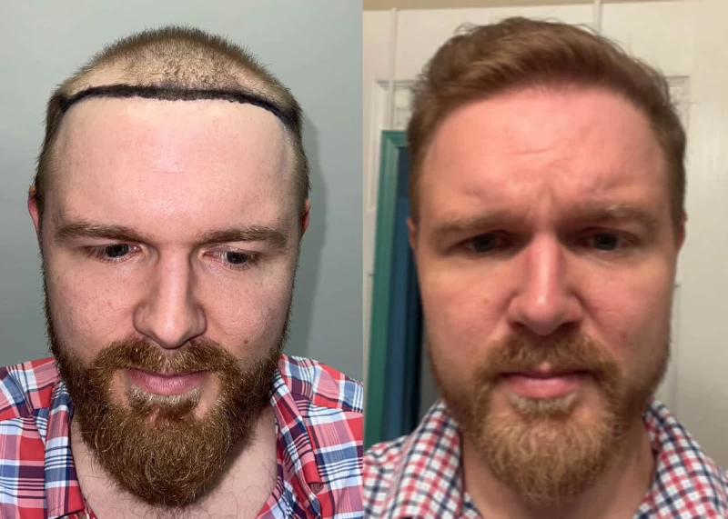 Dylan Hair Transplant Before and After