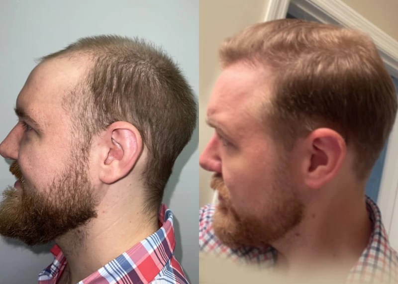 Patient p446 hair transplant before and after left view