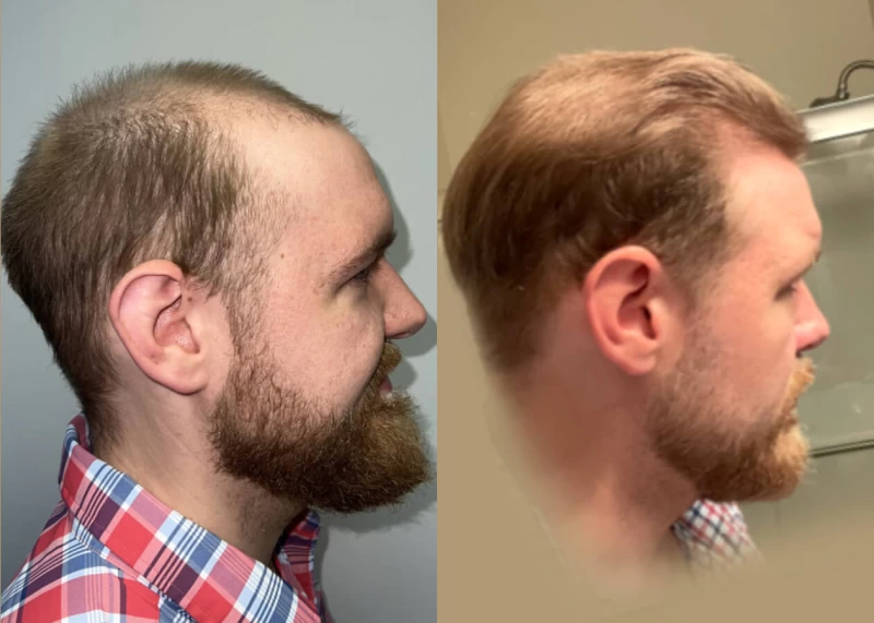 Patient p446 hair transplant before and after right view