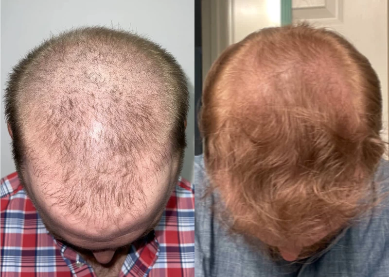 Patient p446 hair transplant before and after tilt view
