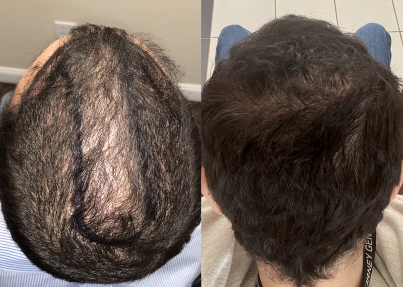Patient p447 hair transplant before and after crown view