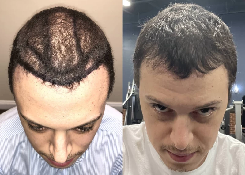 Patient 447 Hair Transplant Before and After