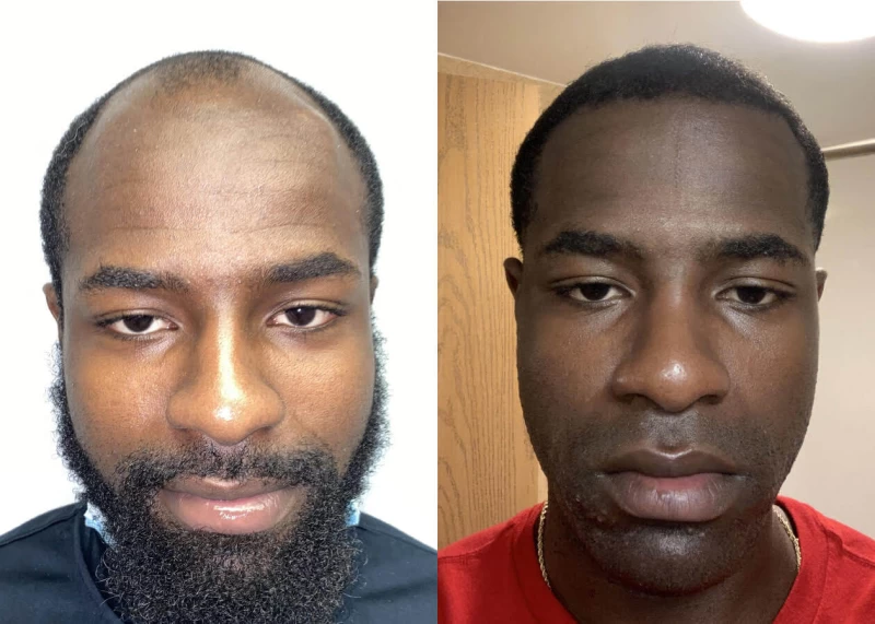 Mario Hair Transplant Before and After