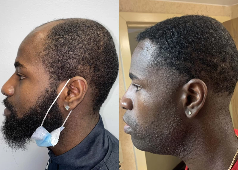 Patient p448 hair transplant before and after left view
