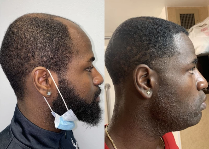 Patient p448 hair transplant before and after right view