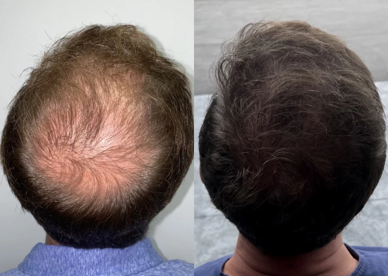 Patient p449 hair transplant before and after crown view