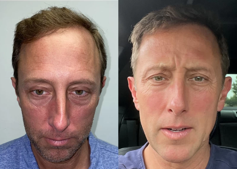 John Hair Transplant Before and After