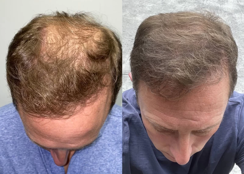 Patient p449 hair transplant before and after tilt view