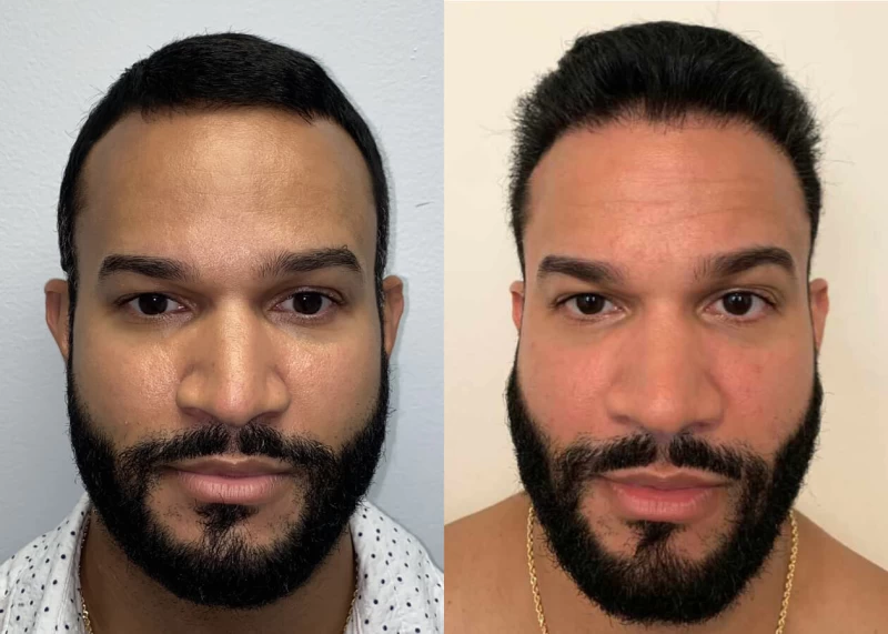 Mr.G Hair Transplant Before and After