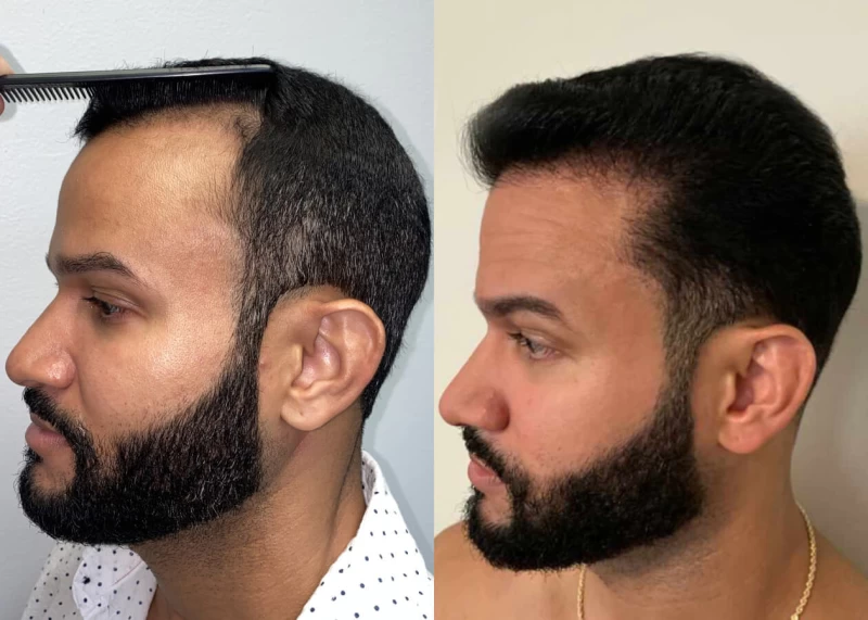 Patient p450 hair transplant before and after left view