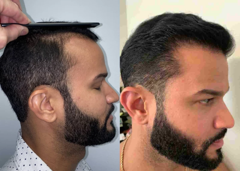 Patient p450 hair transplant before and after right view