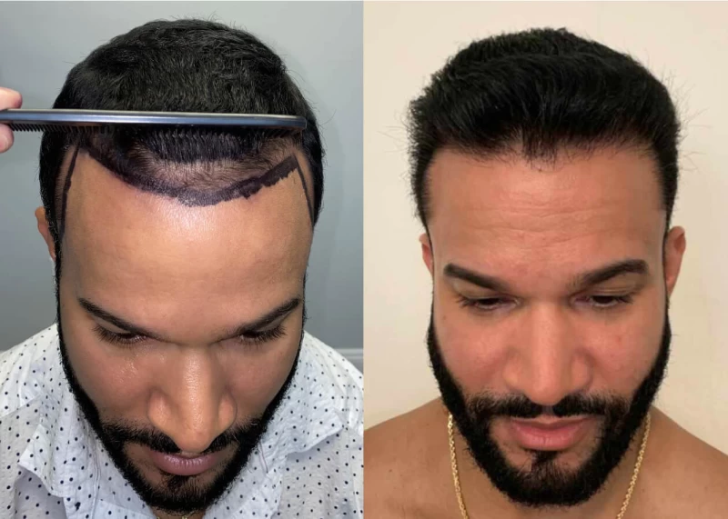 Patient p450 hair transplant before and after tilt view