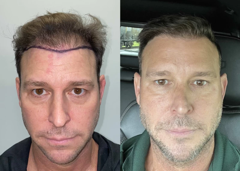 Mr.P Hair Transplant Before and After